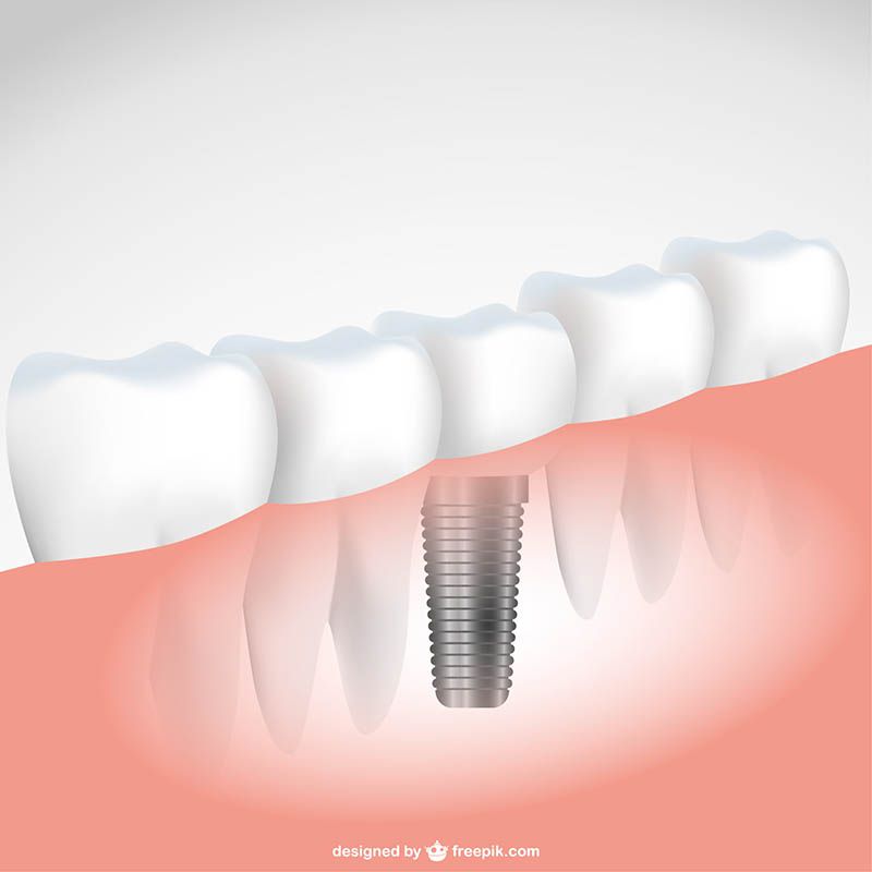 Implante dentário em Diadema
